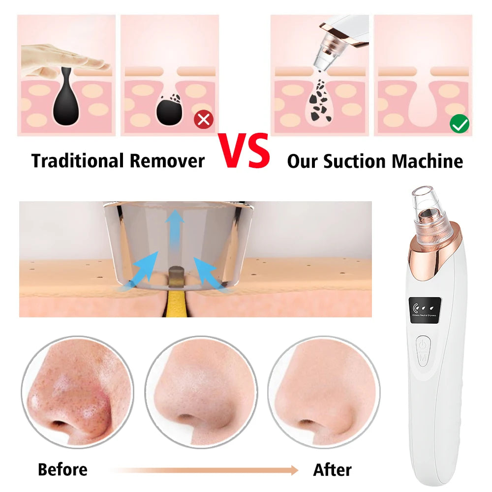 USB Rechargeable Blackhead Remover